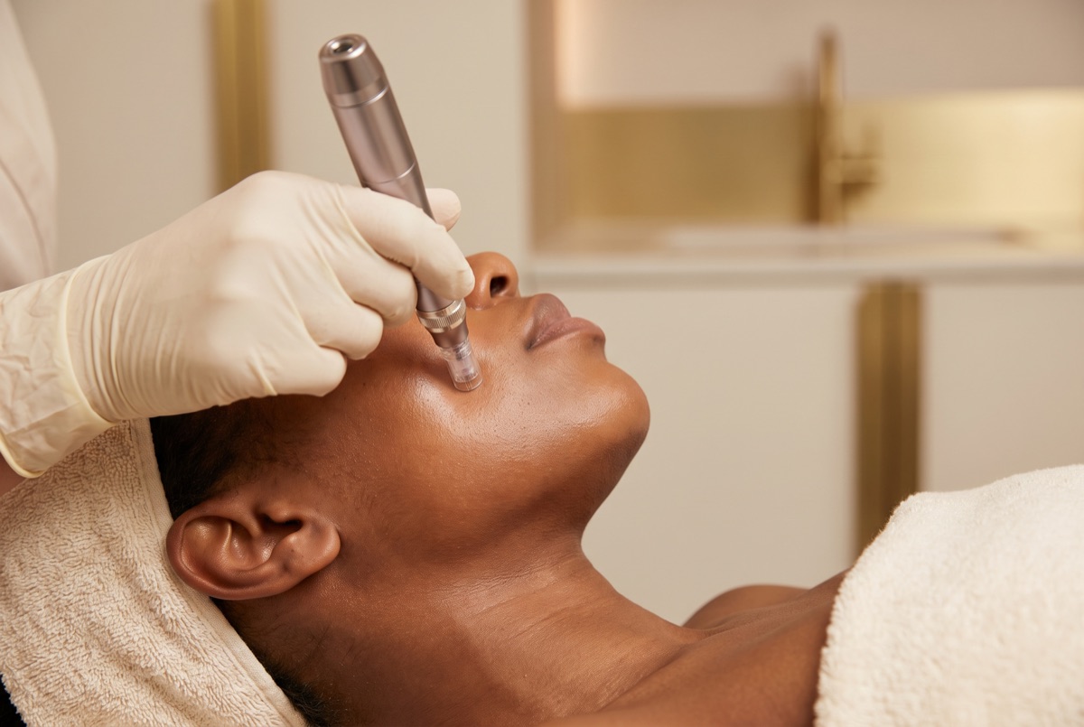 Microneedling with PRP skin rejuvenation on melanin-rich skin