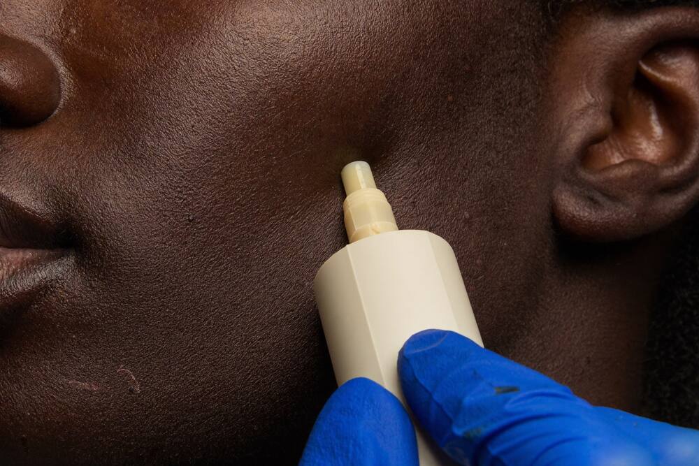 Microneedling for texture & pores